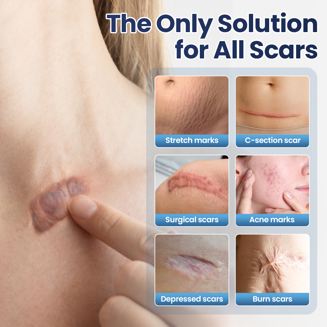 🔥Last Day Discount🔥 Nexisify® DERMALUX Texture Repair Gel